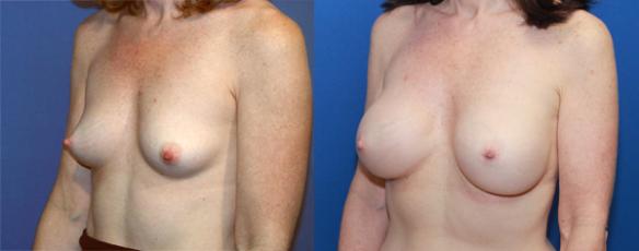 Breast augmentation saline implant full C cup 17 years after